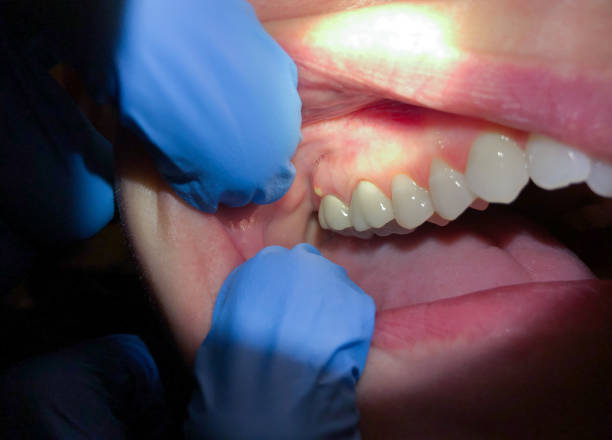 Best Emergency Dental Care for Broken or Chipped Teeth in Menahga, MN
